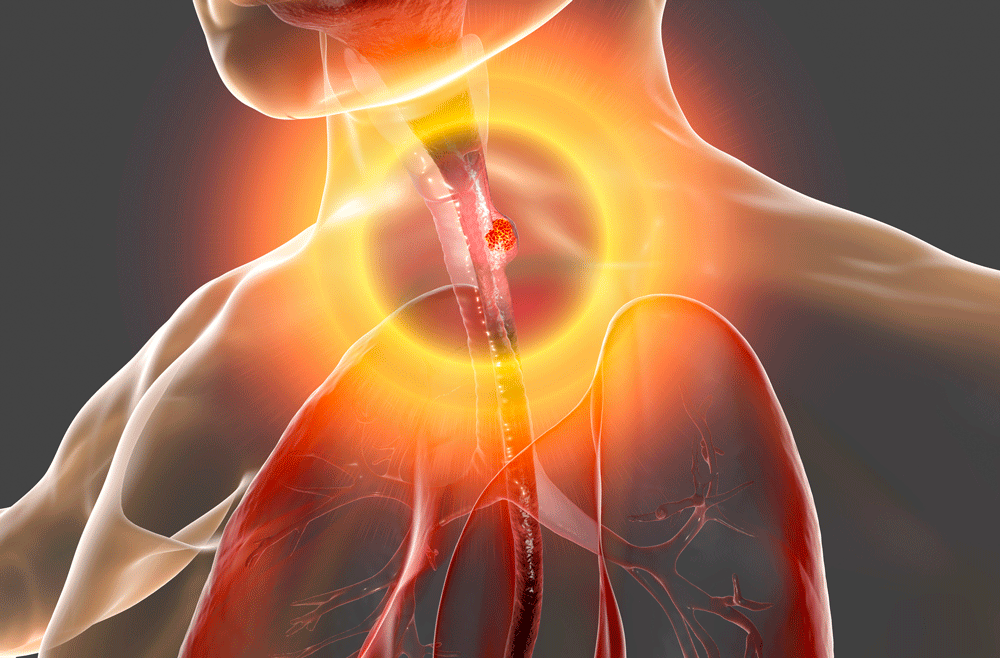 esophageal-cancer-abramson-cancer-center